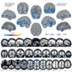 Blue regions show areas where gray matter volume decreased; Orange represents areas where gray matter increased. (Image: University of Michigan)